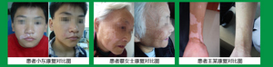 成人白癜风症状有哪些