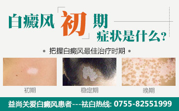 深圳市白癫疯医院讲解哪些白癜风的症状告诫您疾病的来袭