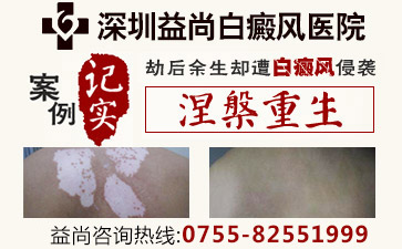 深圳宝安区最好的白癜风医院是哪家？白癜风病人的预防要加强自我防护